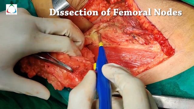 Groin node dissection смотреть онлайн