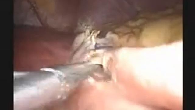 Laparoscopic Gastrectomy 1 (Antrectomy with Billroth II Procedure) смотреть онлайн