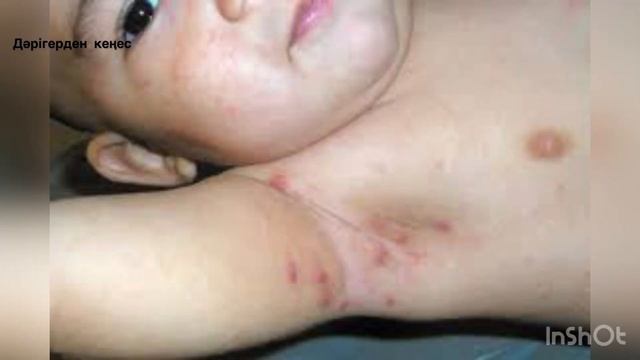 ҚЫШЫМА ауруы. Қышыманың белгілері. ЧЕСОТКА. Чесотка симптомы .Чесотка как выглядит. Чесотка қазақша