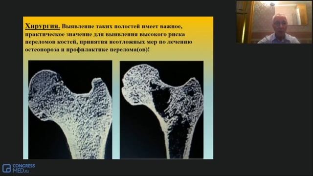Как лечить постпенопаузальный остеопороз. Доклад профессора Струкова
