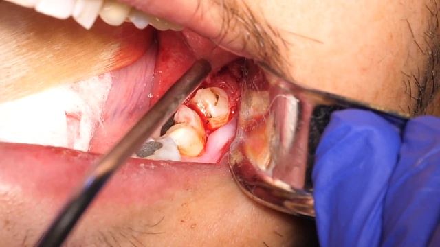 Wisdom Tooth #17 Surgical Extraction Demonstration смотреть онлайн