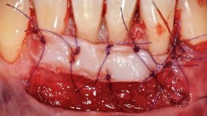 Хирургическое лечение рецессии десны 1.9