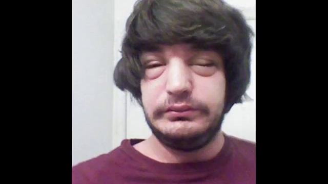 Ужасные последствия после укусов пчел. The terrible consequences after the bee stings. смотреть онлайн