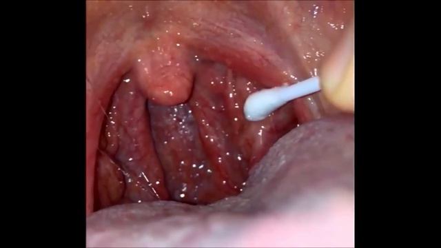 Гной в горле, удаление в домашних условиях смотреть онлайн