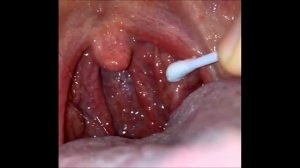 Гной в горле, удаление в домашних условиях