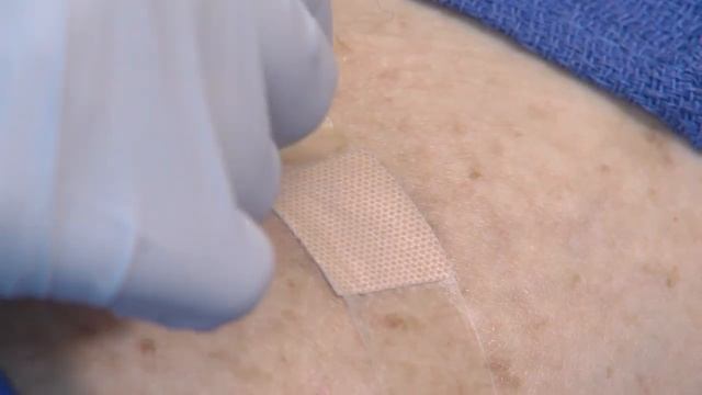 How to Take Out Your Stitches after Skin Procedures смотреть онлайн
