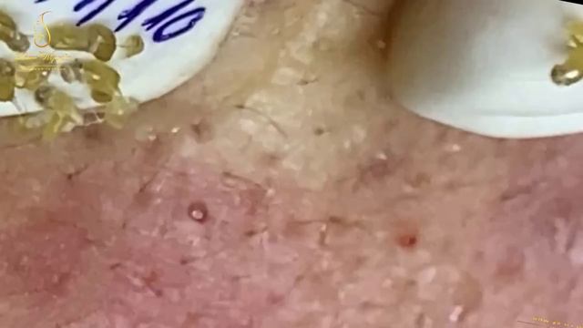 Loan Nguyen Acne Treatment 1435mh смотреть онлайн