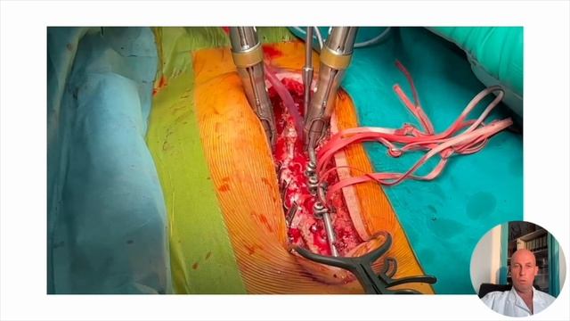 “AVDT” - Apical Vertebral Derotation and Translation in AIS смотреть онлайн