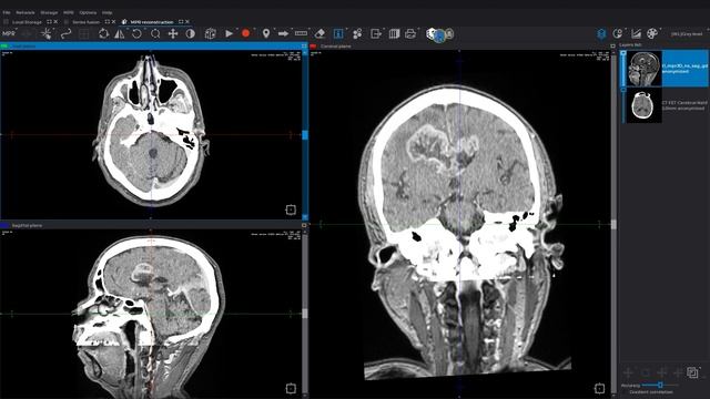 Series fusion and registration with Inobitec DICOM Viewer смотреть онлайн