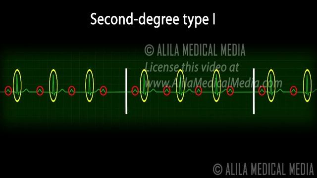 Heart Blocks, Anatomy and ECG Reading, Animation. смотреть онлайн