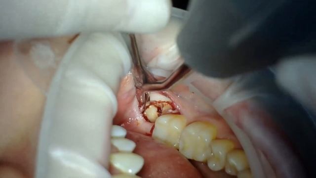 УДАЛЕНИЕ ЗУБА МУДРОСТИ \ WISDOM TOOTH EXTRACTION смотреть онлайн