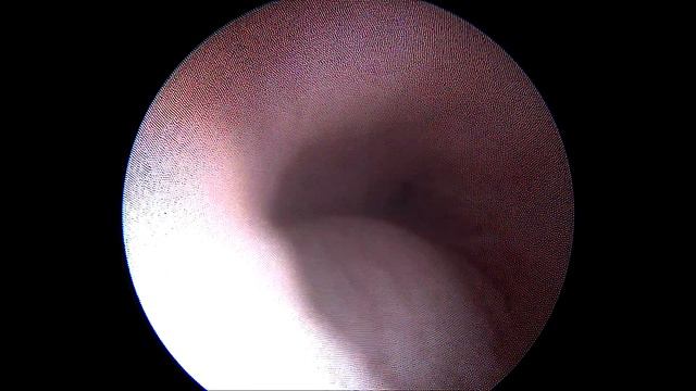 Парауретральная киста смотреть онлайн