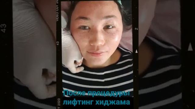 До и после процедуры лифтинг хиджамы лица| Капилляротерапия | Кровопускание смотреть онлайн