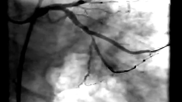 T STENT ТЕХНИКА ДЛЯ ЛЕЧЕНИЯ БИФУРКАЦИЙ СОСУДОВ СЕРДЦА смотреть онлайн