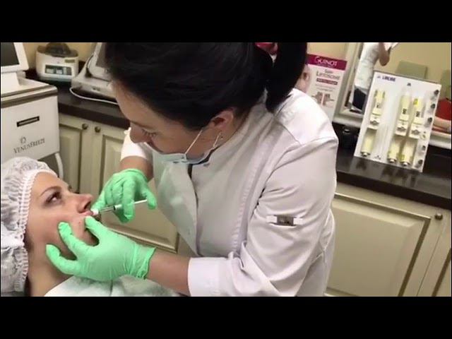 ФИЛЛЕРЫ В НОСОГУБНЫЕ СКЛАДКИ - коррекция морщин смотреть онлайн