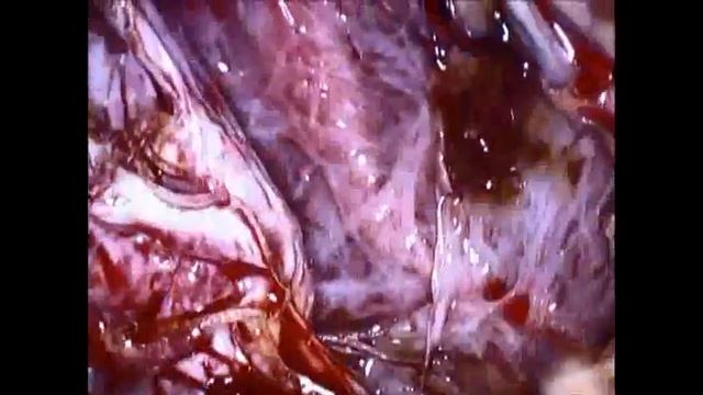 Total Lap resection liver cyst x 2 and liver biopsy.MP4 смотреть онлайн
