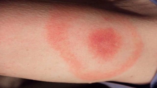 ЧТО БУДЕТ ЕСЛИ УКУСИТ ШЕРШЕНЬ? смотреть онлайн