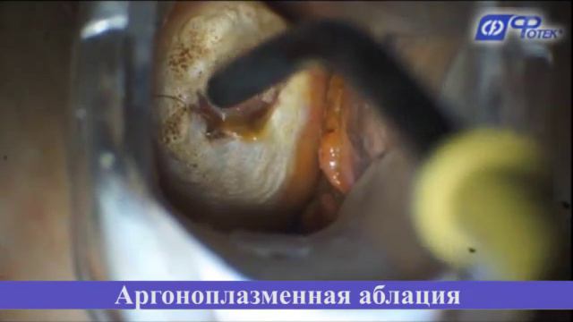 NEW Аргоноплазменная коагуляция при лейкоплакии шейки матки смотреть онлайн