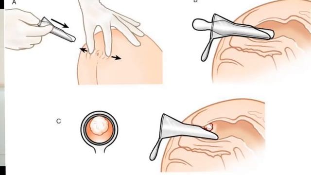 GET RID OF ANAL FISSURE | भगन्दर गुदा फिशर मलनाली दर्द का इलाज | Dr.Education (Hindi) смотреть онлайн