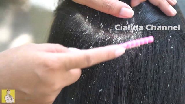 Hair Combing Dandruff / Cialina Channel 1139