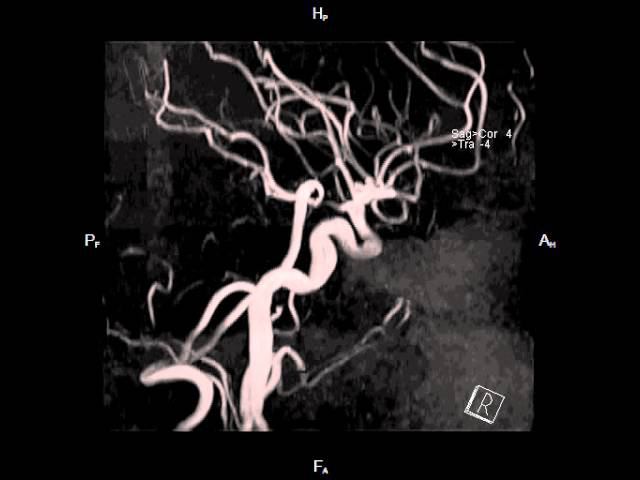 Магнитно резонансная ангиография артерий головного мозга смотреть онлайн