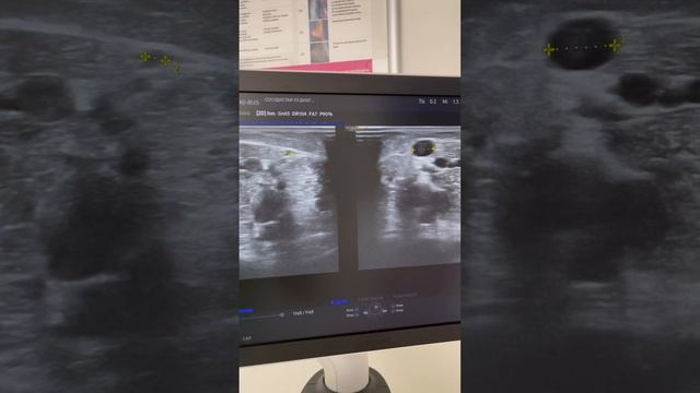 Наследственная предрасположенность к варикозу. Флеболог Москва. Флеболог. Лечение варикоза. смотреть онлайн