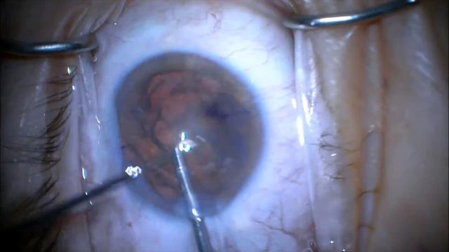 Bausch + Lomb Victus Femto Cataract Surgery With Zero Phaco Handpiece