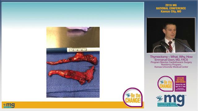 MG Conference 2018: Thymectomy 07 смотреть онлайн