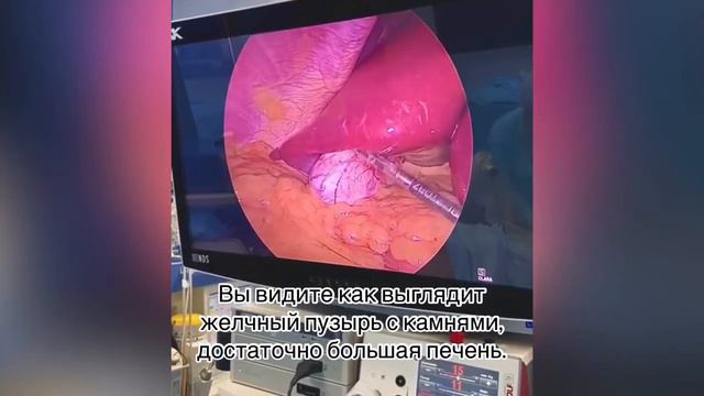 Минигастрошунтирование пациентке с ИМТ 44 и желчекаменной болезнью смотреть онлайн