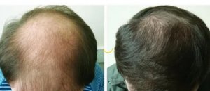 Супер-рецепт для волос, начинают расти даже на лысинах!