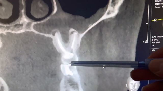 Одонтогенный гайморит на компьютерной томографии. Удаление "кисты" зуба. Периодонтит. Гранулема зуб смотреть онлайн