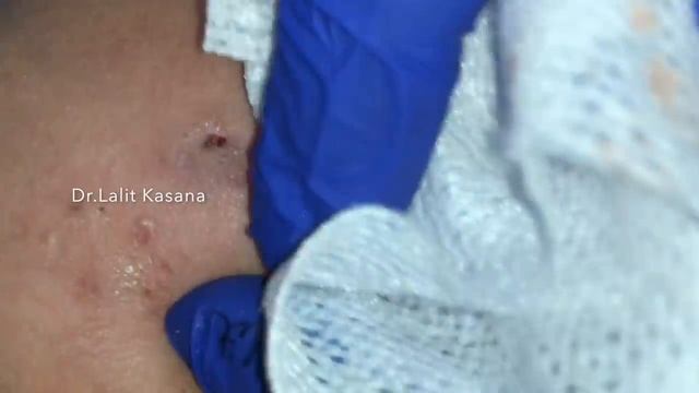 BIG DEEP WHITEHEADS AND SEBACEOUS CYST REMOVAL by Dr.Lalit Kasana смотреть онлайн