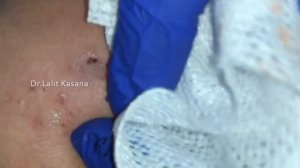 BIG DEEP WHITEHEADS AND SEBACEOUS CYST REMOVAL by Dr.Lalit Kasana