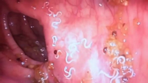 Глисты в организме человека паразиты симптомы, профилактика и лечение глистов