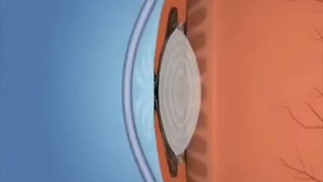 Первичная глаукома смотреть онлайн