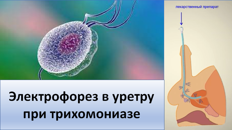 Электрофорез в уретру при трихомониазе смотреть онлайн