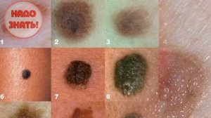 Почему появляются родинки на теле?