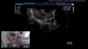 Практическое занятие: УЗИ органов малого таза у женщин (пациентка 1)