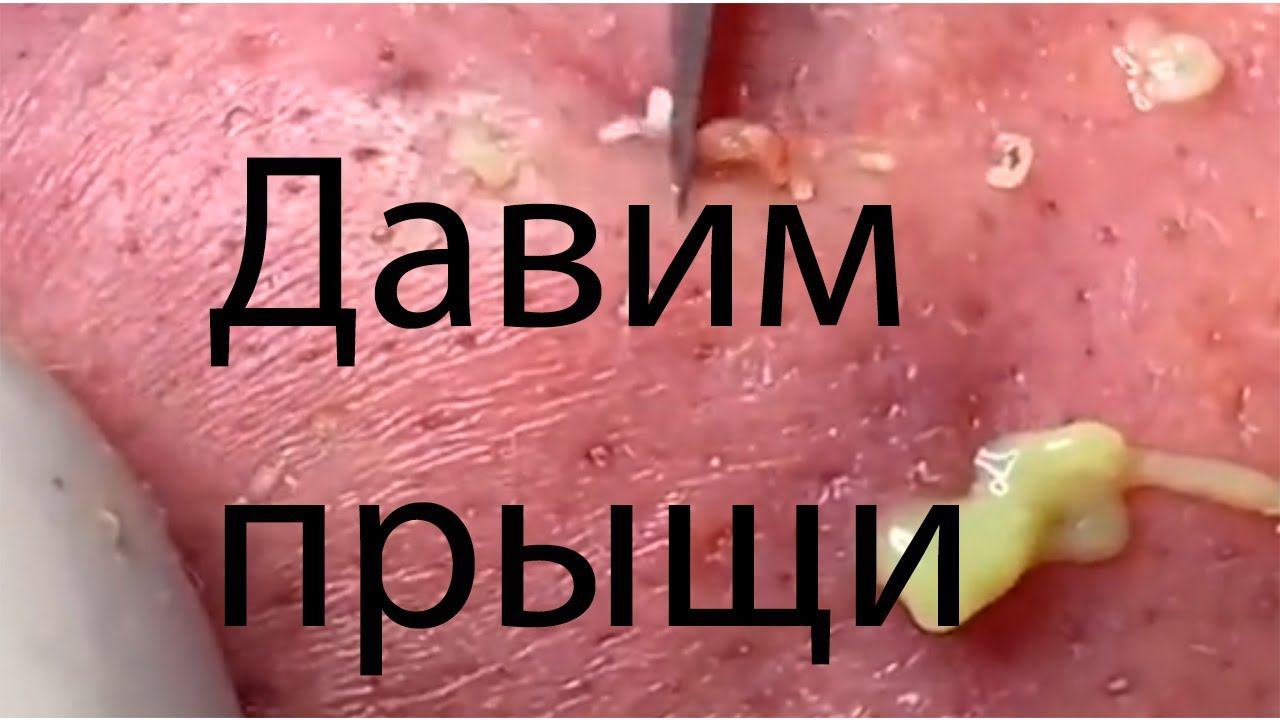 Мега огромная подборка удаления прыщей, чёрных точек, угрей. #22 смотреть онлайн