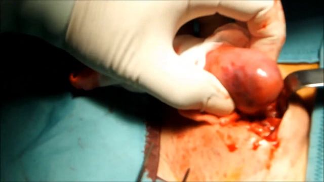 Roberto Vellucci M.D - J.P.Panourgias M.D Surgical approach to a neoplastic inguinal lymph node смотреть онлайн
