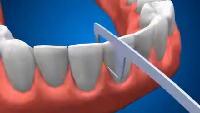 Гигиена полости рта. Использование флосстика смотреть онлайн
