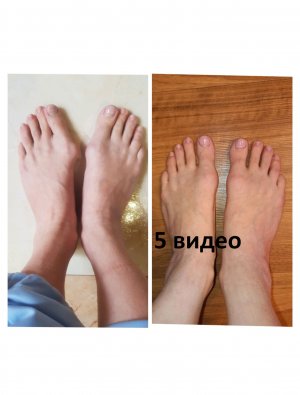 Халюс Вальгус. 6 месяцев после операции.mp4