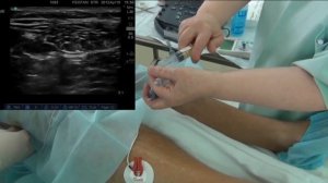 Латерально - дистальная блокада седалищного нерва с катетеризацией