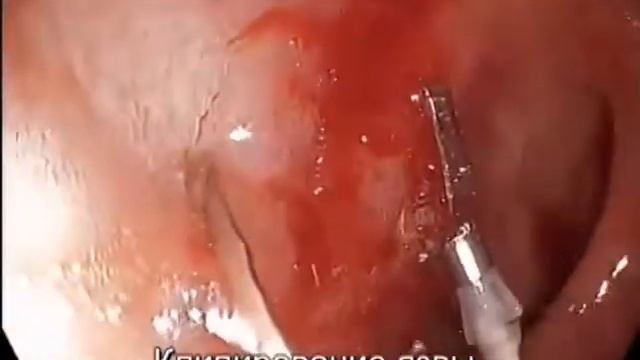 язва луковицы 12-кишки. клипирование и аргоноплазменной коагуляция смотреть онлайн