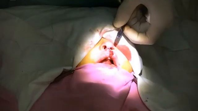 Cleft Lip Repair - Lip Plasty - Хейлопластика - Շրթունքի պլաստիկա - IMed