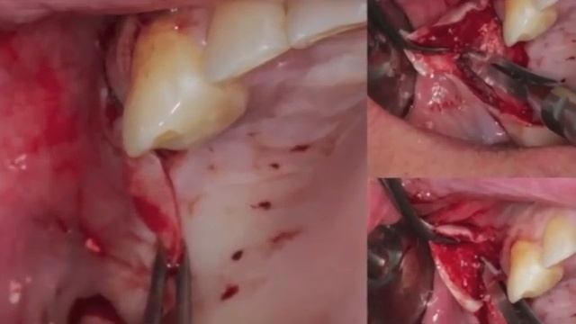 открытый синус-лифтинг смотреть онлайн