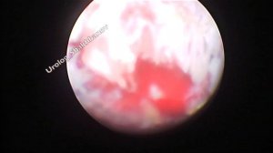 Случай #17. Трансуретральная резекция аденомы предстательной железы.