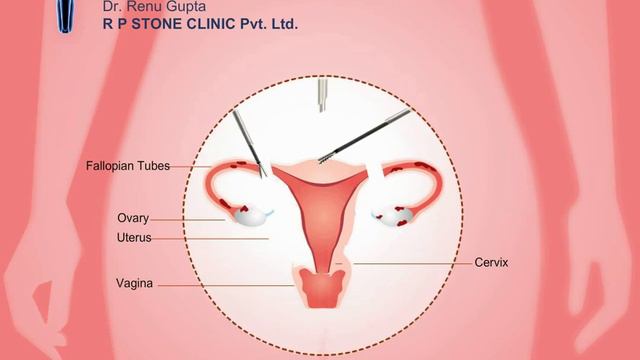 Animation of Total Laparoscopic Hysterectomy смотреть онлайн
