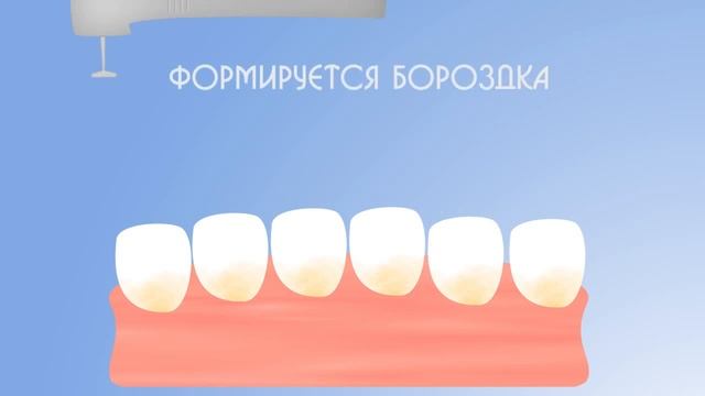 Шинирование зубов подвижных зубов в Полтаве смотреть онлайн