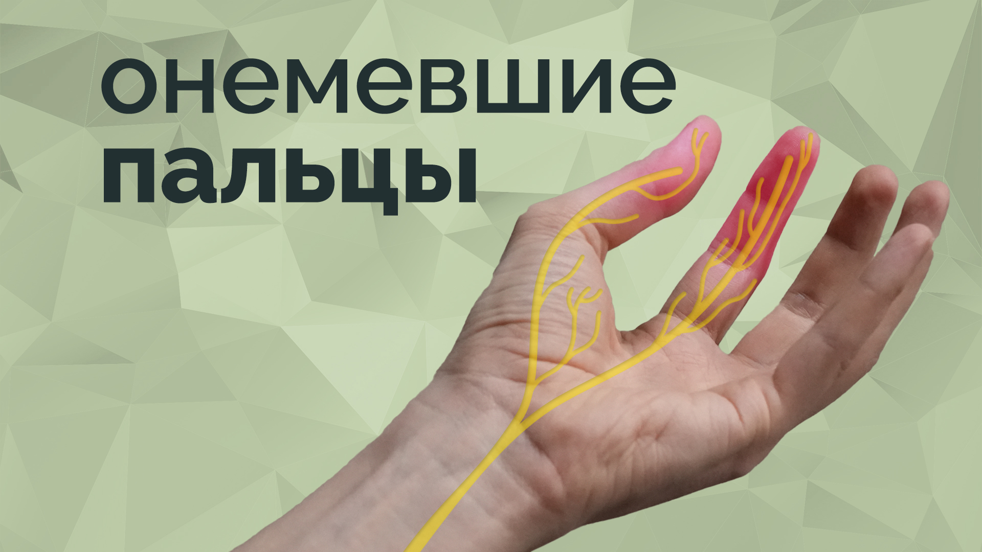 Онемение в пальцах. Отчего это происходит? Как исправить? смотреть онлайн
